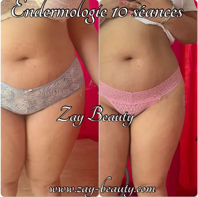 endermo,endermologie,cellu m6,lipomassage,endermo la louvière