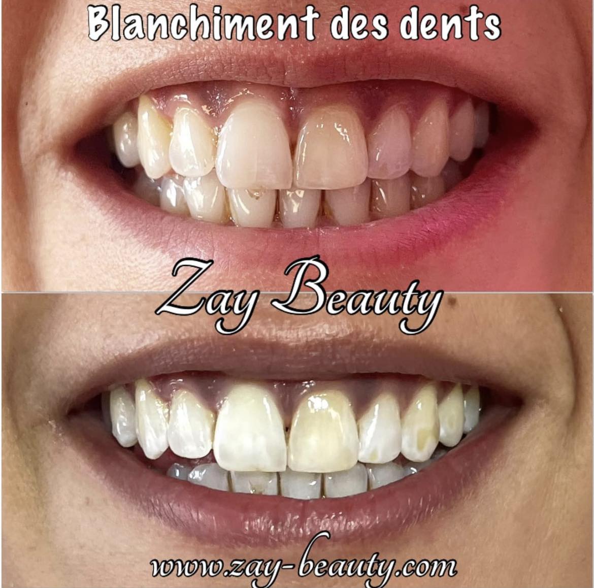 blanchiment des detns,blanchiment dentaire,blanchiment des dents américain,sans peroxyde,sans douleur,blanchiment américain