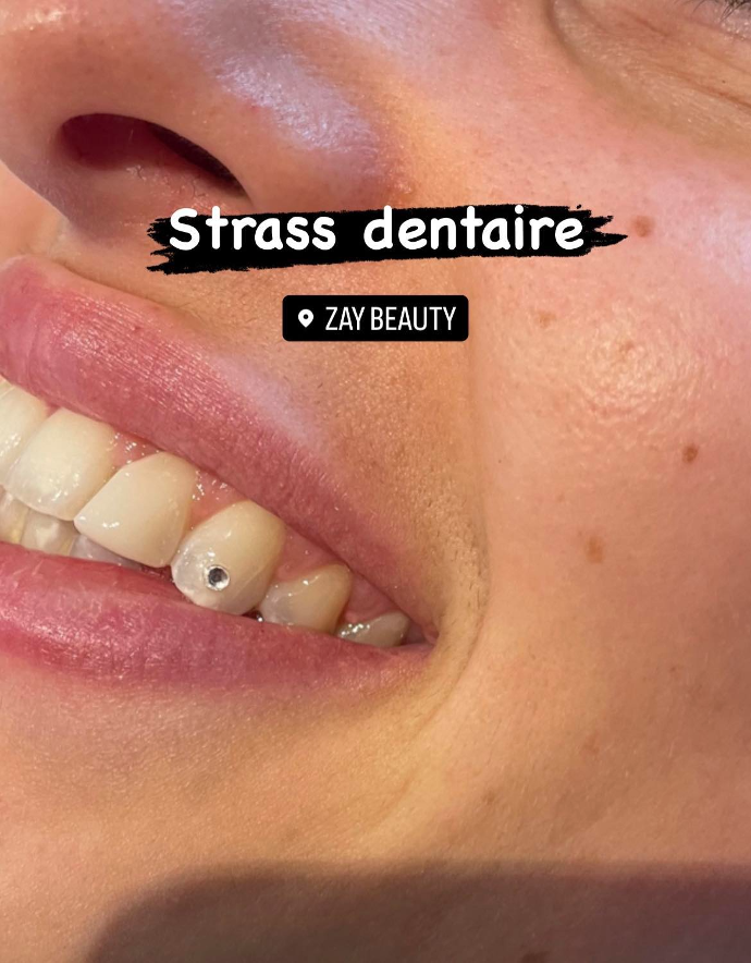 strass dentaire,strass sur dents,pose de strass dentaire la louviere,belgique,hainaut,swarovski dentaire,swarovski,or24K,luxe,brillance sur dents