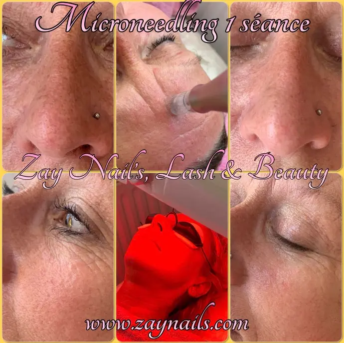 microneedling,microneedling la louvière,rajeunissement de la peau,soin visage,lalouvière,institut de beauté la louvière,resserrer les pores,masque de grossesse,atténuer les rides, ridules,cicatrices,vergetures