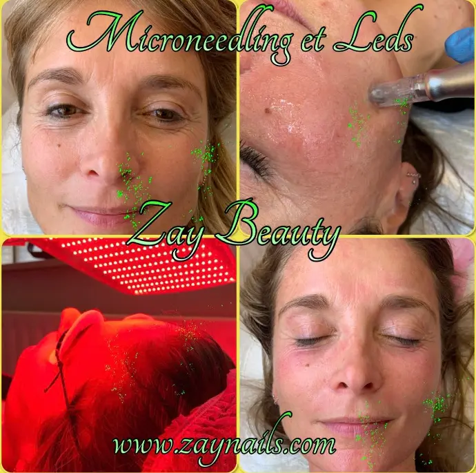 microneedling,microneedling la louvière,rajeunissement de la peau,soin visage,lalouvière,institut de beauté la louvière,resserrer les pores,masque de grossesse,atténuer les rides, ridules,cicatrices,vergetures